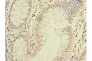 Immunohistochemistry of paraffin-embedded human colon cancer using ABIN7168953 at dilution of 1:100