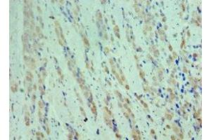 Immunohistochemistry of paraffin-embedded human colon cancer using ABIN7148906 at dilution of 1:100 (CDK9 Antikörper  (AA 153-372))