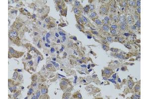 Immunohistochemistry of paraffin-embedded human breast cancer using GNA15 antibody (ABIN5971107) at dilution of 1/100 (40x lens). (GNA15 Antikörper)