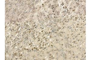 ABIN6261622 and ABIN6273240 at 1/100 staining human melanoma by IHC-P. (ETV5 Antikörper  (Internal Region))