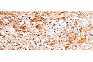 Immunohistochemistry of paraffin-embedded Human liver cancer tissue using NADK Polyclonal Antibody at dilution of 1:70(x200) (NADK Antikörper)