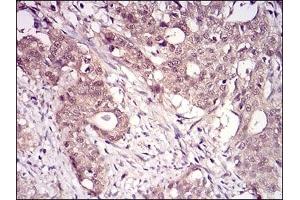 Immunohistochemical analysis of paraffin-embedded human cervical cancer tissues using RANBP9 mouse mAb with DAB staining. (Importin 9 Antikörper  (AA 453-680))