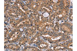 The image on the left is immunohistochemistry of paraffin-embedded Human thyroid cancer tissue using ABIN7131459(TRAFD1 Antibody) at dilution 1/20, on the right is treated with fusion protein. (TRAFD1 Antikörper)