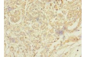 Immunohistochemistry of paraffin-embedded human pancreatic cancer using ABIN7159422 at dilution of 1:100 (MESP1 Antikörper  (AA 149-268))