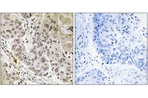 Immunohistochemistry analysis of paraffin-embedded human lung carcinoma tissue, using STK36 Antibody. (STK36 Antikörper  (AA 387-436))