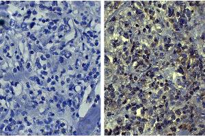 Paraffin embedded human kidney cancer tissue was stained with Mouse IgG1-UNLB isotype control followed by HRP conjugated Anti-Mouse Ig secondary antibody, DAB, and hematoxylin. (MMP2 Antikörper)