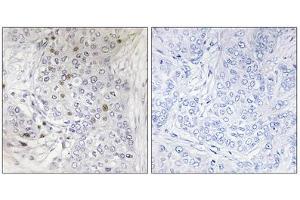 Immunohistochemistry analysis of paraffin-embedded human breast carcinoma tissue, using MAFF antibody. (MafF Antikörper  (Internal Region))
