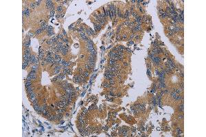 Immunohistochemistry of Human colon cancer using PRKD3 Polyclonal Antibody at dilution of 1:50 (PRKD3 Antikörper)