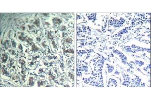 Immunohistochemical analysis of paraffin-embedded human breast carcinoma tissue using PLC-γ1 (Ab-771) Antibody (E021523). (Phospholipase C gamma 1 Antikörper)