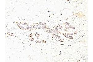 Formalin-fixed, paraffin-embedded human breast carcinoma stained with SMMHC antibody (MYH11/923 + SMMS-1). (MYH11 Antikörper)