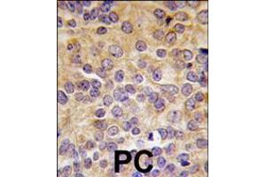 Formalin-fixed and paraffin-embedded human prostata carcinoma tissue reacted with PRMT3 antibody (N-term), which was peroxidase-conjugated to the secondary antibody, followed by DAB staining. (PRMT3 Antikörper  (N-Term))