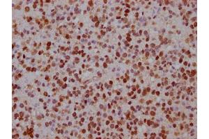 IHC image of ABIN7152619 diluted at 1:100 and staining in paraffin-embedded human glioma cancer performed on a Leica BondTM system. (FABP4 Antikörper  (AA 6-132))