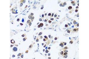 Immunohistochemistry of paraffin-embedded Human lung cancer using BRIX1 Polyclonal Antibody at dilution of 1:100 (40x lens). (BRIX1 Antikörper)
