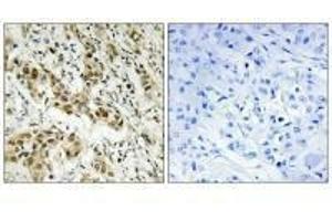 Immunohistochemistry analysis of paraffin-embedded human breast carcinoma tissue using CtBP1 (Ab-422) antibody. (CTBP1 Antikörper  (Ser422))