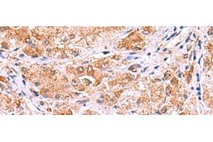 Immunohistochemistry of paraffin-embedded Human liver cancer tissue using UXS1 Polyclonal Antibody at dilution of 1:60(x200) (UXS1 Antikörper)