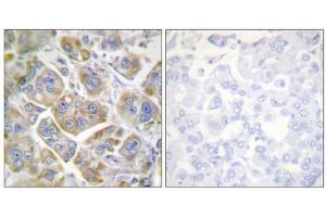 Immunohistochemistry analysis of paraffin-embedded human breast carcinoma tissue using ITGB4 (epitope around residue 1510) antibody. (Integrin beta 4 Antikörper  (Tyr1510))