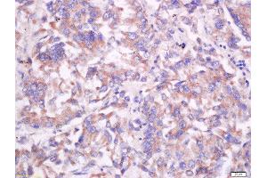 Formalin-fixed and paraffin embedded human lung carcinoma labeled with Anti-CD55/DAF Polyclonal Antibody, Unconjugated  at 1:200 followed by conjugation to the secondary antibody and DAB staining. (CD55 Antikörper  (AA 301-381))