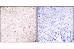 Immunohistochemistry analysis of paraffin-embedded human breast carcinoma tissue, using p300/CBP Antibody. (KAT2B Antikörper  (AA 783-832))