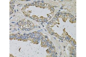 Immunohistochemistry of paraffin-embedded Human prostate using ALDH3A1 Polyclonal Antibody at dilution of 1:100 (40x lens). (ALDH3A1 Antikörper)