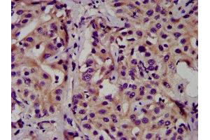 IHC image of ABIN7146788 diluted at 1:500 and staining in paraffin-embedded human liver cancer performed on a Leica BondTM system. (CEACAM16 Antikörper  (AA 323-414))