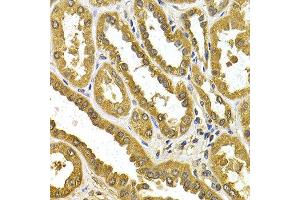 Immunohistochemistry of paraffin-embedded human kidney cancer using UGT1A4 antibody at dilution of 1:200 (400x lens). (UGT1A4 Antikörper)