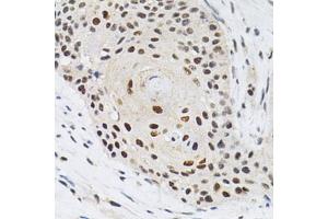 Immunohistochemistry of paraffin-embedded human esophageal cancer using KPNA4 Antibody (ABIN5971058) at dilution of 1/200 (40x lens). (KPNA4 Antikörper)