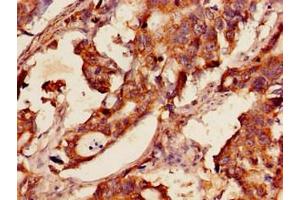 Immunohistochemistry of paraffin-embedded human gastric cancer using ABIN7154080 at dilution of 1:100 (Glutathione Reductase Antikörper  (AA 47-219))