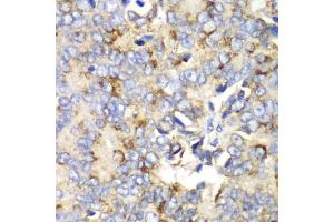 Immunohistochemistry of paraffin-embedded human prostate cancer using TFAM antibody (ABIN6290990) at dilution of 1:100 (40x lens). (TFAM Antikörper)