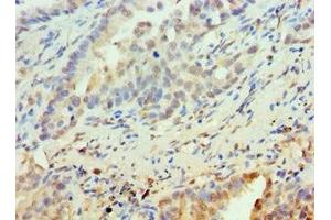 Immunohistochemistry of paraffin-embedded human lung cancer using ABIN7162505 at dilution of 1:100 (PAX6 Antikörper  (AA 1-300))