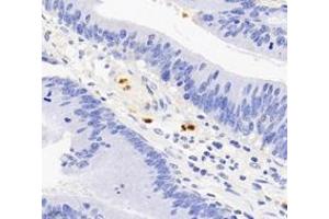 Immunohistochemistry analysis of paraffin-embedded human colon cancer using S100A12 (ABIN7075493) at dilution of 1: 4000 (S100A12 Antikörper)