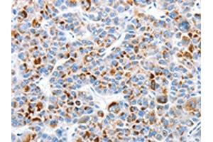 The image on the left is immunohistochemistry of paraffin-embedded Human liver cancer tissue using ABIN7128970(CLIP1 Antibody) at dilution 1/30, on the right is treated with fusion protein. (CLIP1 Antikörper)