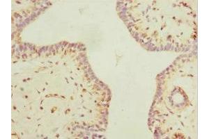 Immunohistochemistry of paraffin-embedded human breast cancer using ABIN7160535 at dilution of 1:100