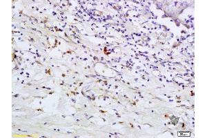 Formalin-fixed and paraffin embedded human breast carcinoma labeled with Anti- TLR5 Polyclonal Antibody, Unconjugated (ABIN673239) at 1:200 followed by conjugation to the secondary antibody and DAB staining
