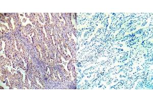 Immunohistochemical analysis of paraffin- embedded human lung carcinoma tissue using AMPKbeta1 (Ab-182) antibody (E022004).
