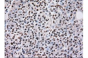 Immunohistochemical staining of paraffin-embedded Adenocarcinoma of breast tissue using anti-SCYL3 mouse monoclonal antibody. (SCYL3 Antikörper)