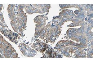 ABIN6277239 at 1/100 staining Human cervical cancer tissue by IHC-P. (SERPINH1 Antikörper  (Internal Region))