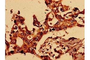 Immunohistochemistry of paraffin-embedded human pancreatic cancer using ABIN7153987 at dilution of 1:100 (NMDAR2A Antikörper  (AA 501-750))