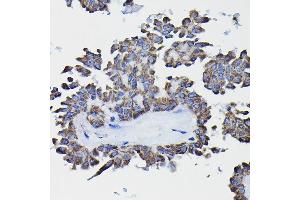 Immunohistochemistry of paraffin-embedded human thyroid cancer using GSTK1 Rabbit pAb (ABIN1680136, ABIN3019398, ABIN3019399 and ABIN6220875) at dilution of 1:25 (40x lens). (GSTK1 Antikörper  (AA 1-226))