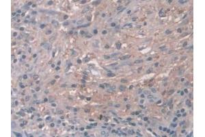 DAB staining on IHC-P; Samples: Human Breast cancer Tissue (Cathepsin Z Antikörper  (AA 24-303))