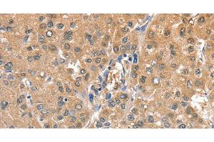 Immunohistochemistry of paraffin-embedded Human liver cancer using CIAPIN1 Polyclonal Antibody at dilution of 1:60 (CIAPIN1 Antikörper)