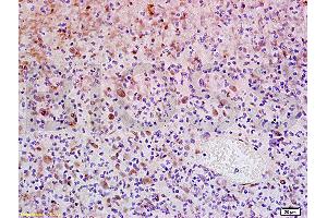Formalin-fixed and paraffin embedded human glioma tissue labeled with Anti-WIG-1/PAG608 Polyclonal Antibody, Unconjugated (ABIN730108) at 1:200, followed by conjugation to the secondary antibody and DAB staining (ZMAT3 Antikörper  (AA 201-288))