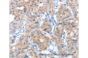 Immunohistochemistry of Human lung cancer using AUP1 Polyclonal Antibody at dilution of 1:50 (Ancient Ubiquitous Protein 1 Antikörper)
