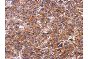 IHC-P Image Immunohistochemical analysis of paraffin-embedded human hepatoma, using SNX9, antibody at 1:500 dilution. (SNX9 Antikörper)