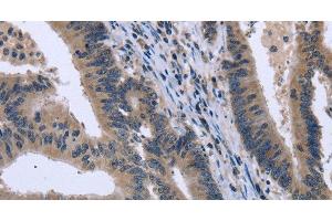 Immunohistochemistry of paraffin-embedded Human colon cancer tissue using KCNJ11 Polyclonal Antibody at dilution 1:40 (KCNJ11 Antikörper)