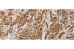 Immunohistochemistry of paraffin-embedded Human colorectal cancer tissue using HOXC5 Polyclonal Antibody at dilution of 1:55(x200) (Homeobox C5 Antikörper)