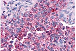 Anti-GPR30 antibody  ABIN1048792 IHC staining of human breast carcinoma. (GPER Antikörper  (Extracellular Domain))