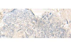 Immunohistochemistry of paraffin-embedded Human esophagus cancer tissue using DIMT1 Polyclonal Antibody at dilution of 1:30(x200) (DIMT1 Antikörper)