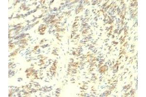 Formalin-fixed, paraffin-embedded human Leiomyosarcoma stained with Transglutaminase 2 antibody. (Transglutaminase 2 Antikörper)