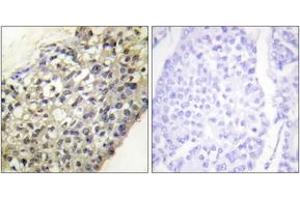 Immunohistochemistry analysis of paraffin-embedded human breast carcinoma tissue, using LATH Antibody.