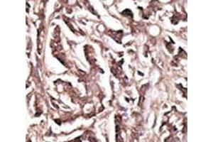 IHC analysis of FFPE human breast carcinoma tissue stained with the APG7 antibody